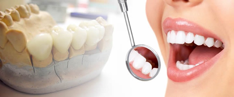 پروتزهای موقت دندان شامل دو نوع آکریلیک و ژله ای هستند